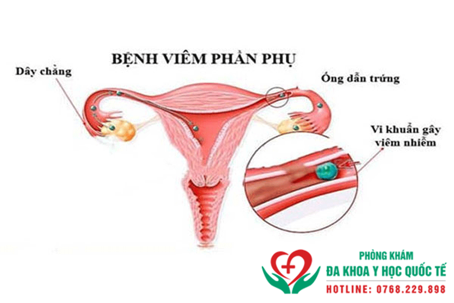 Viêm phần phụ